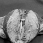 αδενομύωση