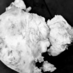 αδενομύωση-2