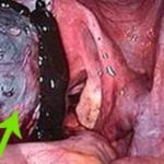 ενδομητρίωση 1