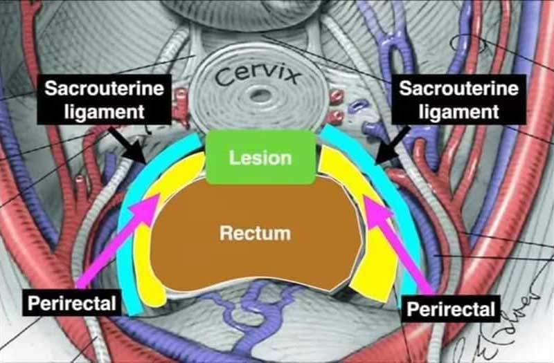 ενδομητρίωση-σχεδιο