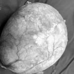 εχινοκοκος-κυστη