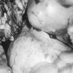 ιδιαίτερο περιστατικό - αφαίρεση μητρας με ινομυώματα