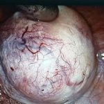 ινομυωμα 3 ινομυωμα 3