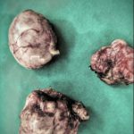 ινομυώματα 2