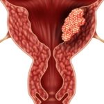 καρκίνος ενδομητρίου καρκίνος ενδομητρίου
