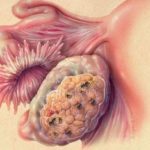 καρκίνος ωοθηκών