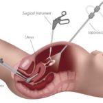 λαπαροσκοπική-χειρουργική