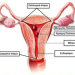 πολύποδας ενδομητρίου