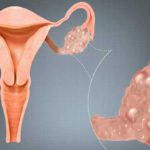 σύνδρομο-πολυκυστικών-ωοθηκών