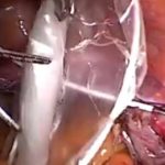 υδροσαλπιγγα