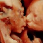 υπερηχογράφημα 2 υπερηχογράφημα 2