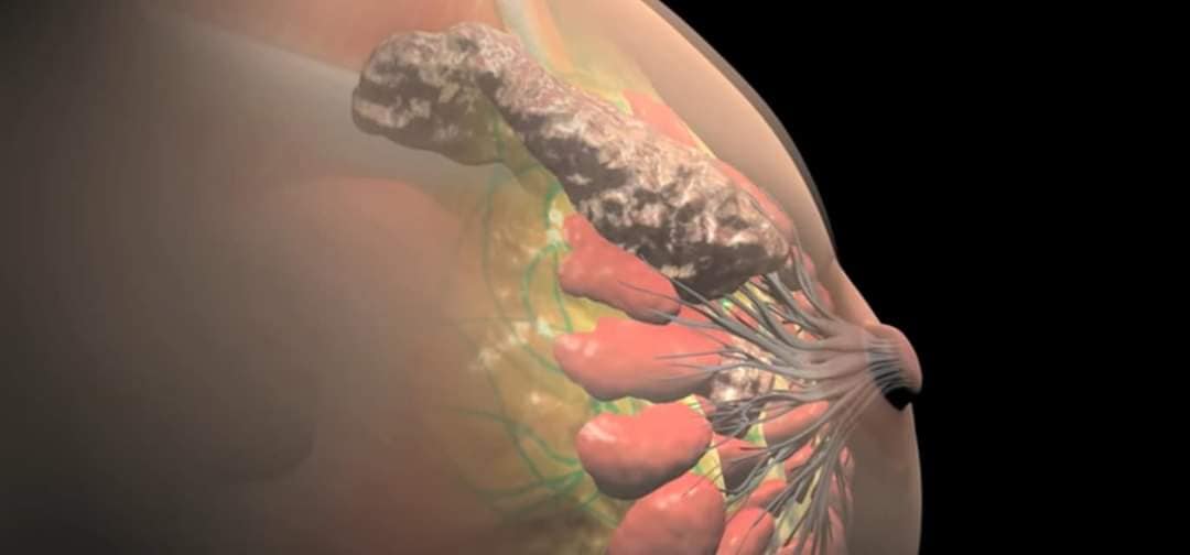 ψηλάφηση μαστού